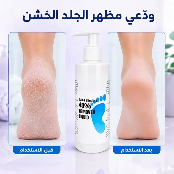 القدم قبل وبعد استعمال سائل إزالة الجلد الخشن